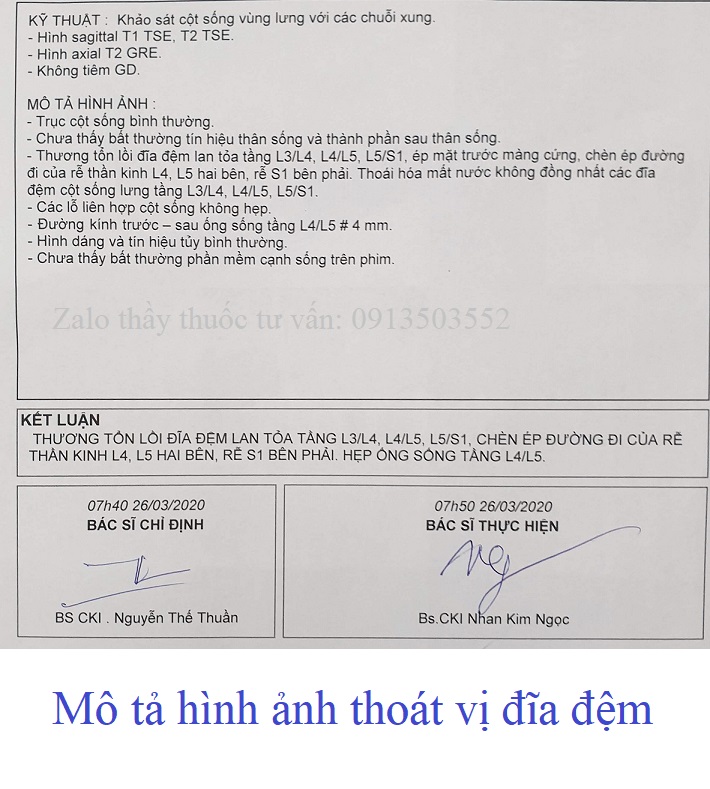 Hình ảnh thoát vị đia đệm 